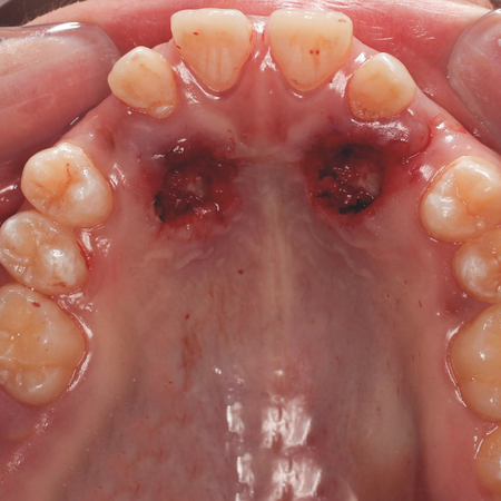Surgical exposure of palatally impacted permanent maxillary canines using the glass-ionomer open exposure (GOPEX) technique: case report