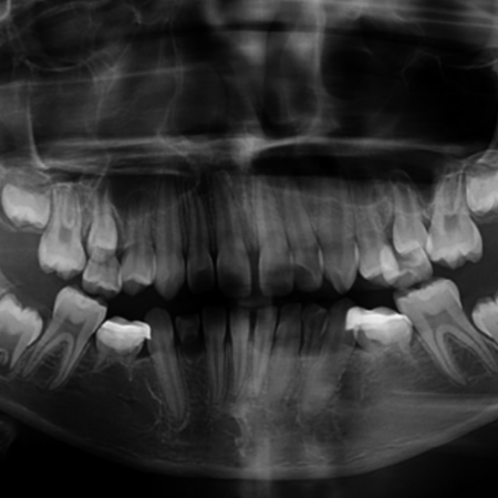 Autotransplante dentário para reabilitação de agenesia de pré-molares inferiores em paciente pediátrico: relato de caso