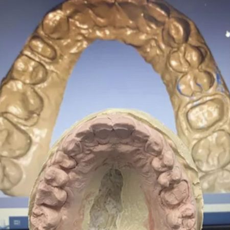 Oral rehabilitation using digital planning and cad/cam with composite resin blocks