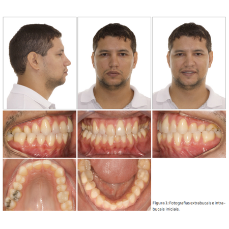 Tratamento de mordida cruzada posterior em adulto com comprometimento periodontal usando uma técnica simples e sem cirurgia