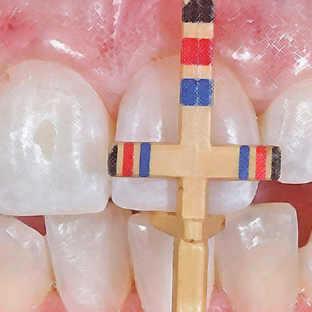 Gingivoplasty associated with osteotomy and direct composite resin veneers: case report with 1-year follow-up