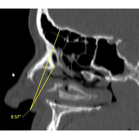 Comparative Tomographic Analysis Of The Frontal Beak And Its Correlations