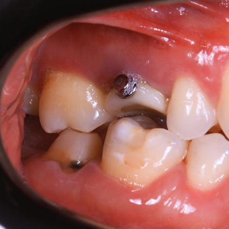 Intrusão do segundo molar superior com ancoragem esquelética