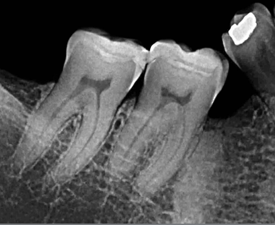 Raízes submersas impedem o tratamento ortodôntico ou o uso de implantes?