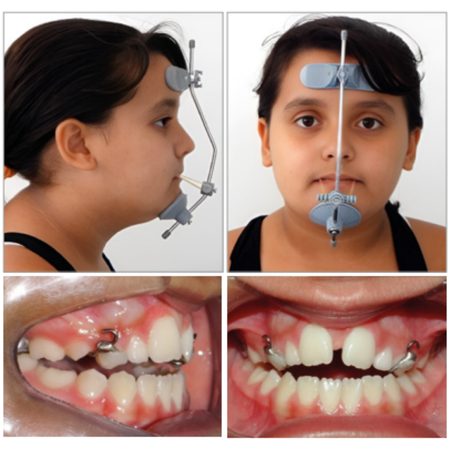 Closing the space of bilaterally missing maxillary lateral incisors in a Class III patient: case report