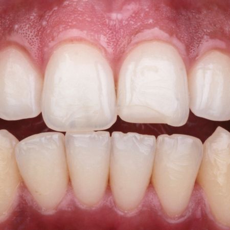 Minimally invasive reshaping of maxillary anterior teeth with composite resin: a case report