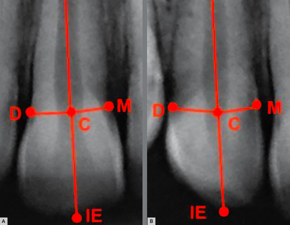 Reabsorção radicular apical externa pós-tratamento ortodôntico: análise em diferentes períodos cronológicos