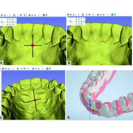 Nova forma de analisar o movimento dentário por meio da sobreposição de único ponto em modelos 3D utilizando a geometria do sistema de coordenadas universal