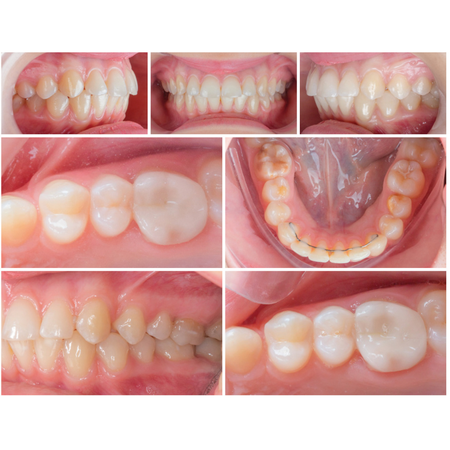 Rapid orthodontic extrusion for molar reconstruction: A case report