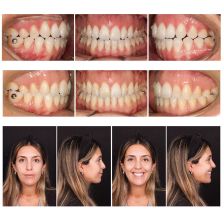 Invisalign para el tratamiento de  mordida abierta anterior