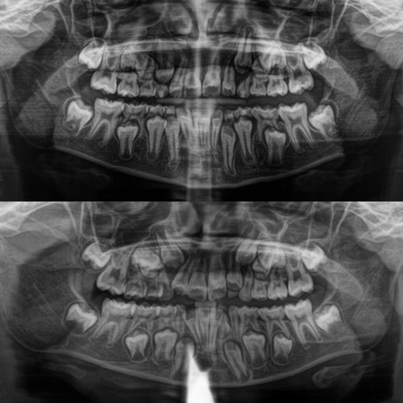 Invisalign First™ in the interceptive treatment of crowding in the mixed dentition: a modern alternative to conventional expanders