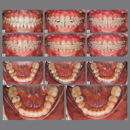 Achieving optimal orthodontic results with hybrid strategies: leveraging the synergy of aligners and fixed appliances