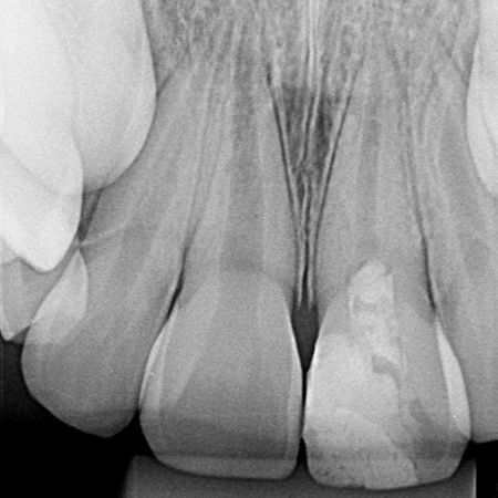 Procedimento endodôntico regenerativo em sessão única, para tratamento de dente permanente imaturo com pulpite irreversível: relato de caso