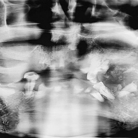 Exérese de fibroma ossificante periférico gigantiforme: Relato de Caso