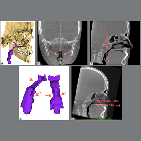 Tomographic analysis of the upper airway: current developments and challenges
