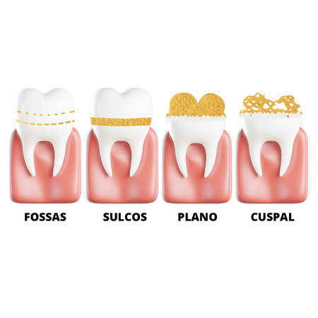 Developmental enamel defects: a must-know for orthodontic practice