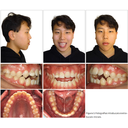 Evaluation of maxillary molars intrusion with modified C-palatal plate in an adolescent patient with anterior open bite and skeletal hyperdivergence: case report