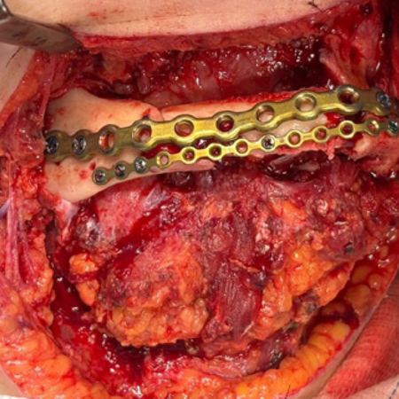 Resection of mandibular cement-ossifying fibroma with fibular graft: a case report