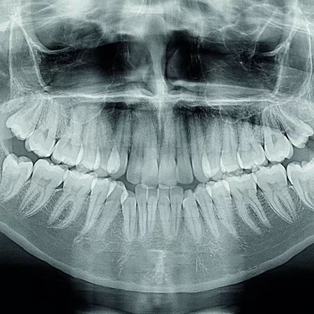 Angle Class II, division 1 malocclusion with bimaxillary protrusion, upper and lower crowding and mandibular retrusion