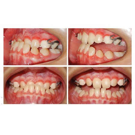Fechamento de espaços com mini-implantes em paciente Classe III esquelética com agenesia dentária múltipla: relato de caso