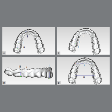 Effect of print layer height on the accuracy and fit of the rapid-prototyped retainers