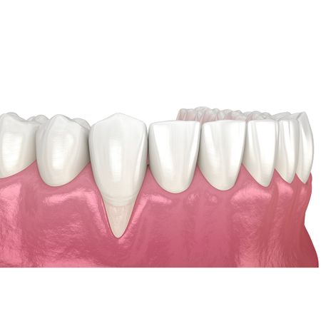 Mucogingival biomodulation technique in the treatment of unitary retraction in mandibular incisor: case report