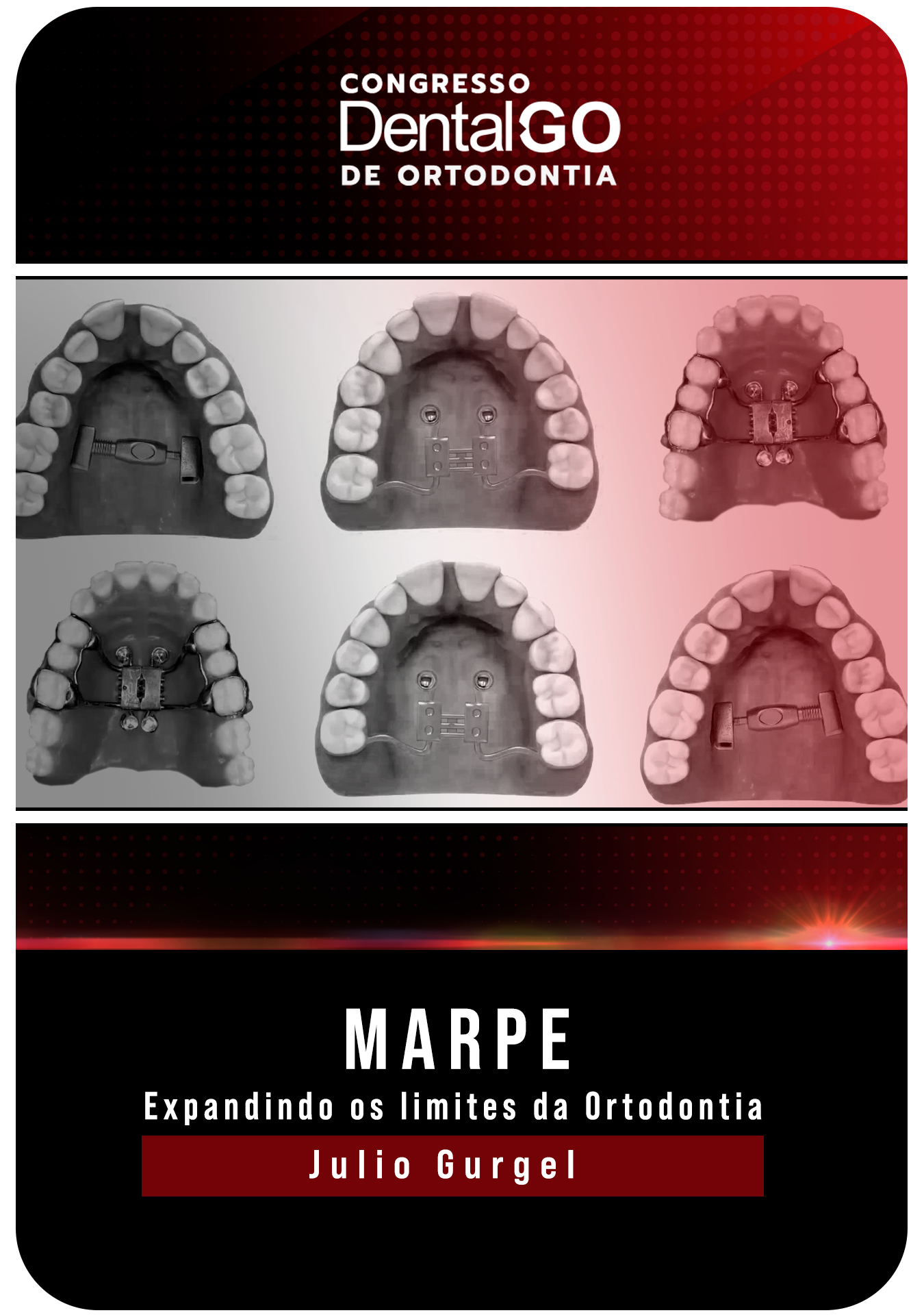 Julio Gurgel - MARPE - Expandindo os limites da Ortodontia