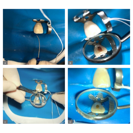 Regenerative endodontic therapy for general practitioners: a case report