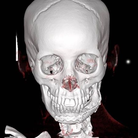 Mandibular odontogenic myxoma: case report