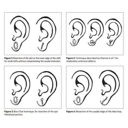 EAR LOBULOPLASTY: INDICATIONS AND SURGICAL TECHNIQUES — LITERATURE REVIEW