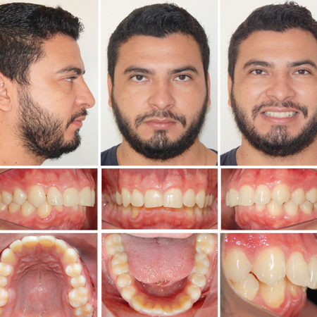 Uso de alinhadores transparentes Invisalign associados a bite ramps no tratamento da sobremordida profunda: relato de caso