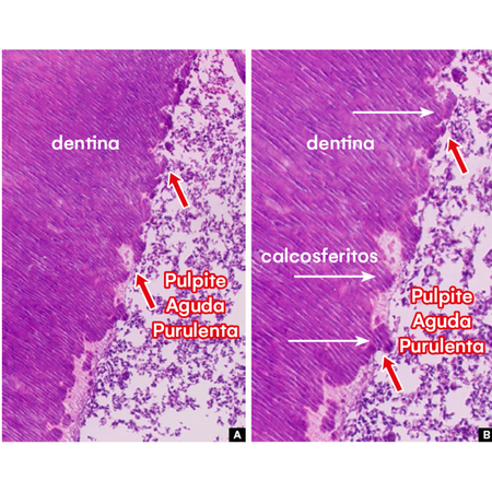 Importance of calcospherites in the dentin wall of canals prepared for filling