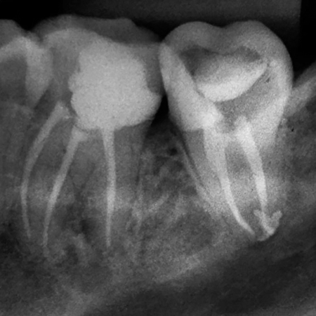 Endodontic treatment of a mandibular second molar with a C-shaped canal configuration: a case report