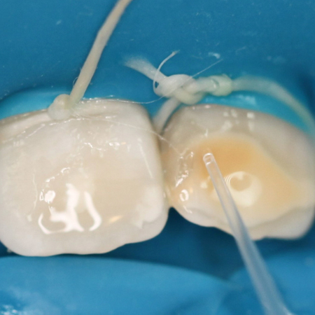 Resin Infiltration for Developmental Defects of Enamel: A One-Year Follow-up Study