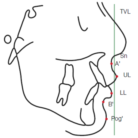 Evaluation of the three-dimensional positioning of the inferior alveolar nerve for orthognathic surgery