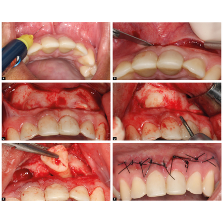 Uso de dentes supranumerários como substitutos para incisivos centrais superiores impactados: relato de caso com acompanhamento de 8 anos