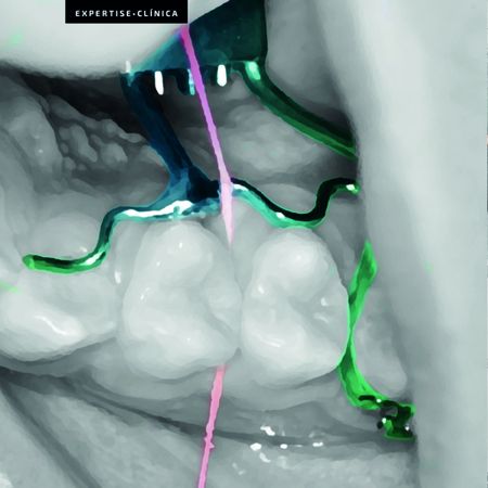 Expander appliance design adapted to facilitate flossing