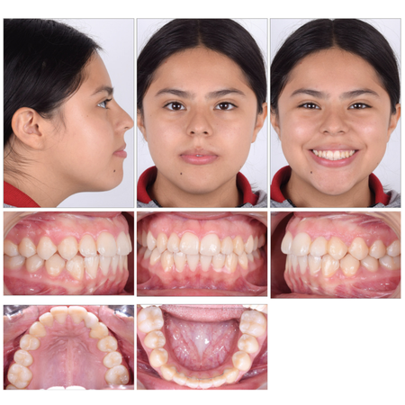 Management of bilateral impacted maxillary canines with resorbed lateral incisor: a case report