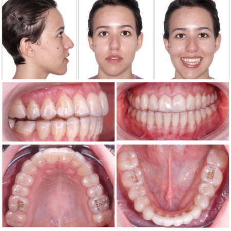 Eficácia do Invisalign® na correção compensatória de Classe III associada à mordida aberta anterior