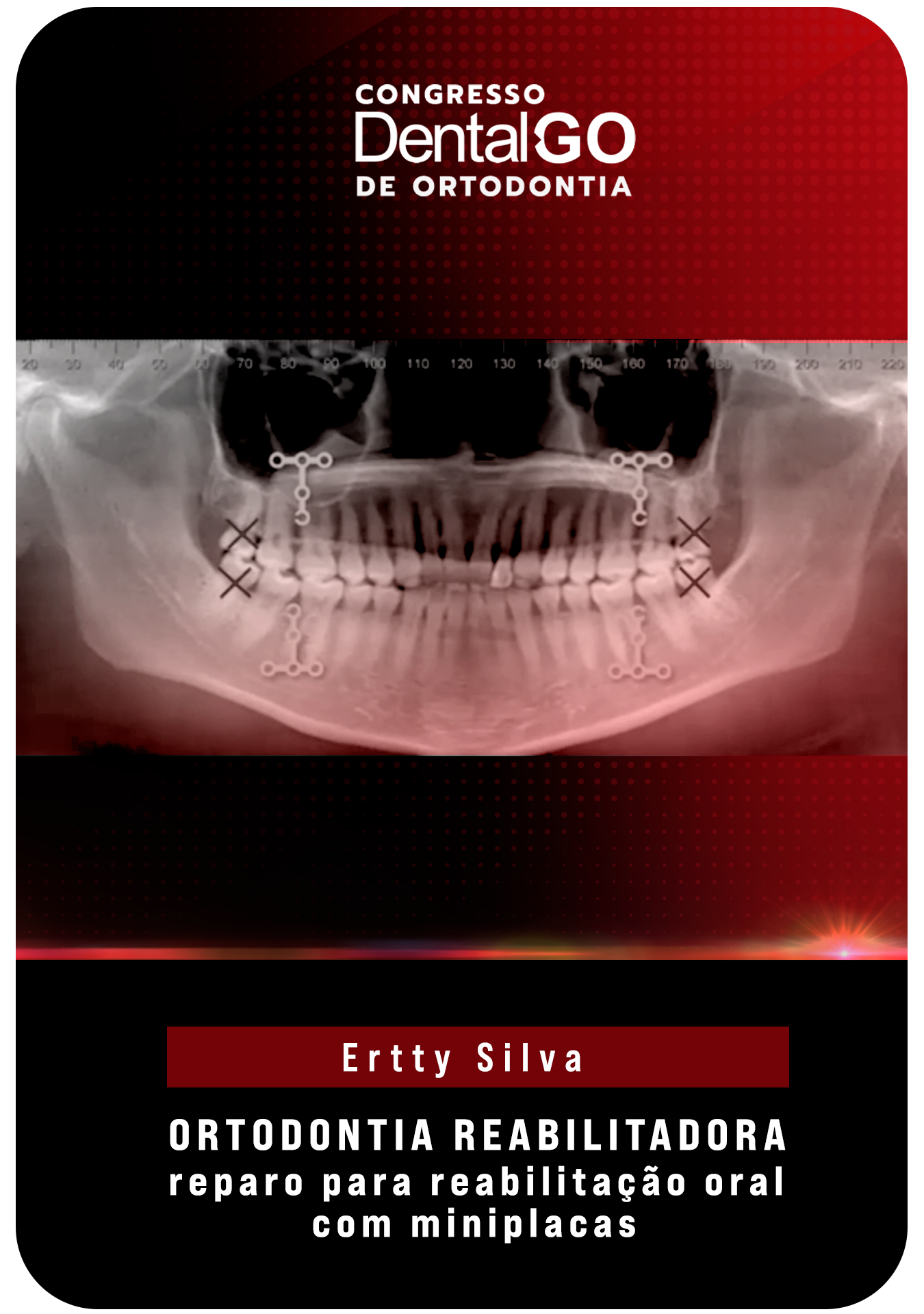Ertty Silva - Ortodontia reabilitadora, reparo para reabilitação oral com miniplacas