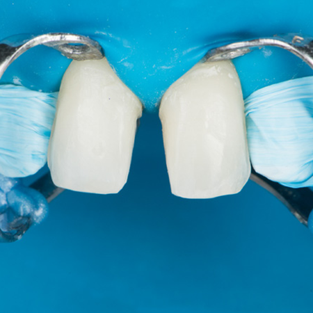 AESTHETIC REHABILITATION using CERAMIC LAMINATES CEMENTED WITH PREHEATED RESIN: CASE REPORT