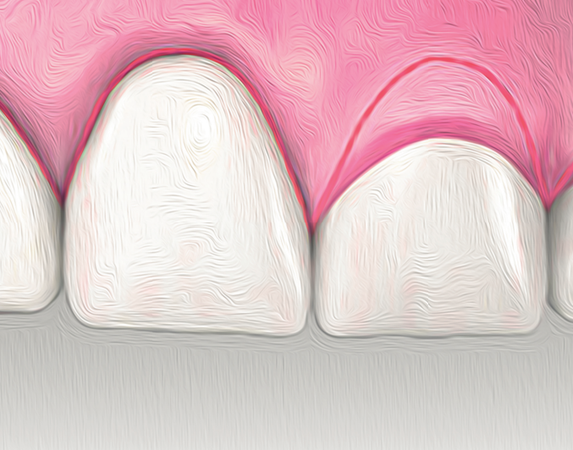 Cirurgia plástica periodontal: técnica cirúrgica e experiência do operador como determinantes de sucesso — revisão narrativa