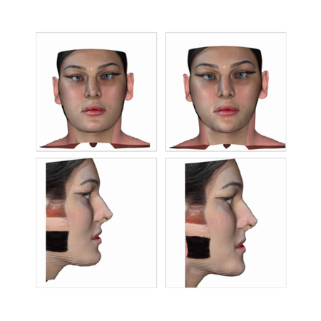 Beyond genioplasty: revisiting the mandible in gender-affirming facial surgery