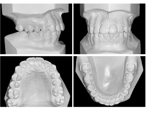 Abordagem da Classe II esquelética severa por retrognatismo mandibular: relato de caso