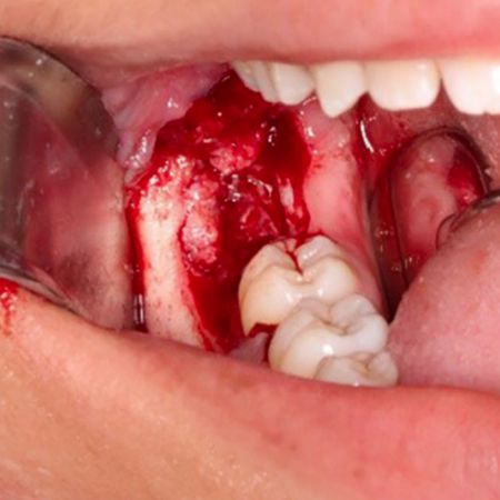 Conservative approach of an plexiform ameloblastoma on a young patient: case report