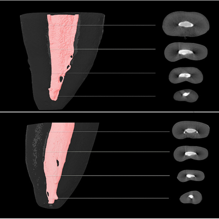 Microtomographic analysis of endodontic thermoplastic obturation of flattened canals with ultrasonic vertical condensation