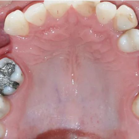 Treatment of Class III patient with multiple missing teeth and anterior crossbite: case report