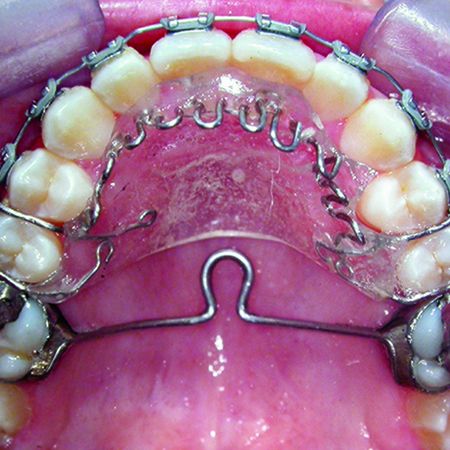 Skeletal open bite treated with headgear, chincup and tongue therapy: case report with 15-year stability