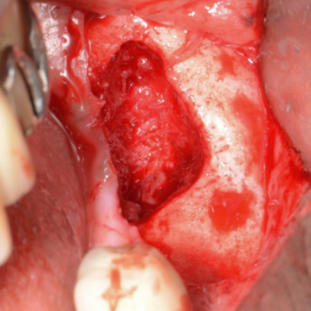 Utilização da doxiciclina na cirurgia guiada por imunofluorescência para melhores respostas no tratamento da osteonecrose dos maxilares