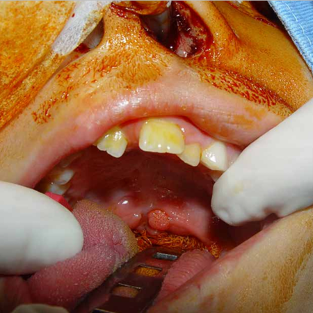 Squamous oral papilloma in child: case report